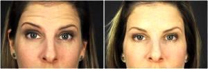 Forehead & Crowsfeet Botox By Goesel Anson, MD, FACS, Plastic Surgeon In The Clark County, Nevada (5)