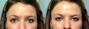 Forehead Injections By Dr. Steven Pearlman, Plastic Surgeon In New York City, New York