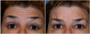 Forehead Lines Botox At Allure Plastic Surgery, Miami FL (1)