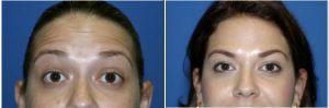 Forehead Lines Botox At Allure Plastic Surgery, Miami FL (2)
