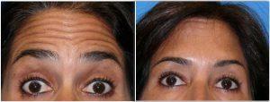 Forehead Lines Botox At Allure Plastic Surgery, Miami FL (4)