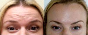 Forehead Lines Botox At Skin By Lovely, Portland OR (1)