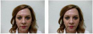 Forehead Lines Botox By Clayton Frenzel, Doctor In Arlington, Texas