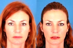 Forehead Lines Botox By Dr. Benjamin Bassichis, Dallas Plastic Surgeon