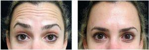 Forehead Lines Botox By Dr. Joshua Lampert, MD,FACS, Miami FL Plastic Surgeon (1)