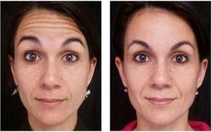 Forehead Lines Botox By Dr. Joshua Lampert, MD,FACS, Miami FL Plastic Surgeon (2)