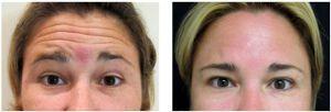 Forehead Lines Botox By Dr. Joshua Lampert, MD,FACS, Miami FL Plastic Surgeon (3)