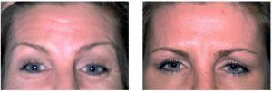 Forehead Lines Botox By Dr. Surjit S. Rai, MD, Dallas TX Physician