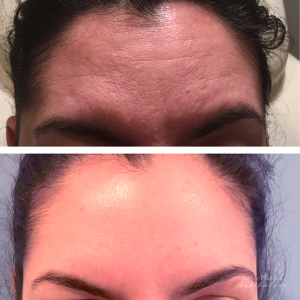 Forehead Lines By JENNIFER CANESI, APN-BC, Board Certified Adult Nurse Practitioner In Boston
