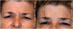 Forehead Lines By Onelio Garcia Jr., M.D., Plastic Surgeon In Miami, Florida (3)