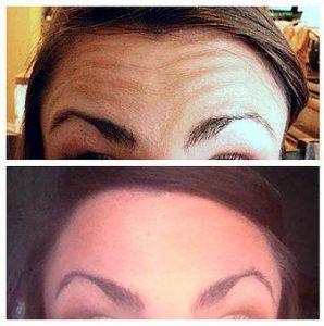 Forehead Lines Correction With Botox At CASA Aesthetics Of San Antonio