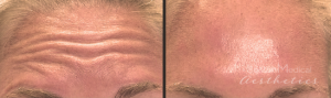 Forehead Lines Injections By JENNIFER CANESI, APN-BC, Board Certified Adult Nurse Practitioner In Boston