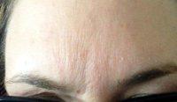 Forehead Lines Make Us Look Tired, Angry, Anxious Or Worried