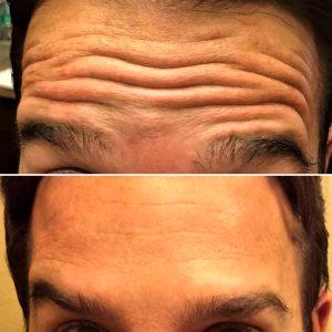 Forehead Male Botox At Facial Aesthetics In Denver