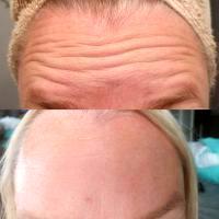 Forehead Wrinkles Botox Before And After