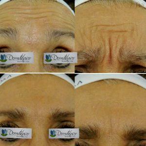 Forehead Wrinkles Botox Photos (1)
