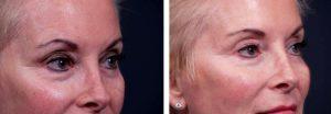 Frown Lines And Small Wrinkles Around Eyes Treated With Botox By Dr. Shaun Parson, Plastic Surgeon In Scottsdale, Arizona