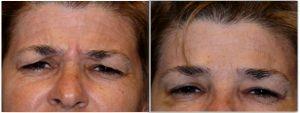 Frown Lines At Allure Plastic Surgery, Miami FL (1)