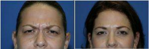 Frown Lines At Allure Plastic Surgery, Miami FL (2)