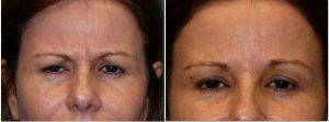 Frown Lines At Allure Plastic Surgery, Miami FL (3)