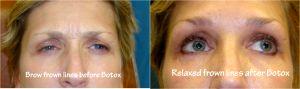 Frown Lines At Always Beautiful Medspa, Medical Spa In Aurora, Colorado