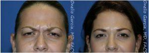Frown Lines Botox By Dr Onelio Garcia Jr., M.D., Plastic Surgeon In Miami, Florida (1)