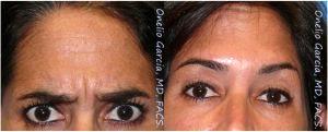 Frown Lines Botox By Dr Onelio Garcia Jr., M.D., Plastic Surgeon In Miami, Florida (2)
