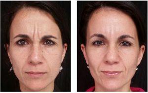 Frown Lines Botox By Dr. Joshua Lampert, MD,FACS, Miami FL Plastic Surgeon (1)