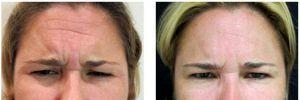 Frown Lines Botox By Dr. Joshua Lampert, MD,FACS, Miami FL Plastic Surgeon (2)