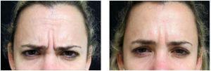 Frown Lines Botox By Dr. Joshua Lampert, MD,FACS, Miami FL Plastic Surgeon (3)