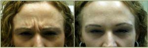 Frown Lines Botox By Dr. Tricia Brown, Dermatologist In Houston, TX