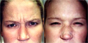 Frown Lines Botox By W. Tracy Hankins, MD, Doctor In The Clark County, Nevada