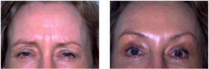 Frown Lines Botox Injections By Dr. Surjit S. Rai, MD, Dallas TX Physician