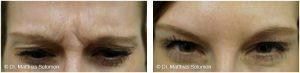 Frown Lines Botox Injections By Matthias Solomon, MD, Dallas Plastic Surgeon