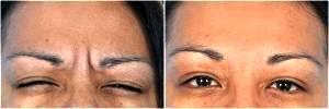 Frown Lines Botox by Dr. Steven H. Dayan, MD, Doctor in Chicago, Illinois