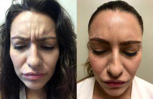Frown Lines By Dr. Shaun Parson, Plastic Surgeon In Scottsdale, Arizona
