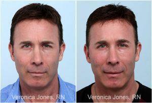 Frown Lines For Man By Veronica Jones, RN At Mirror Mirror Beauty Boutique In Houston, Texas