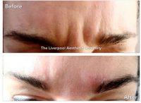 Frown Or Furrow Lines On Forehead