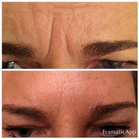 Get Rid Of Brow Furrow Or Glabellar Lines