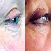 Getting Rid Of Wrinkles Under Eye