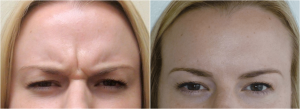Glabella Botox At Skin By Lovely, Portland OR