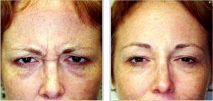 Glabella Botox By W. Tracy Hankins, MD, Doctor In The Clark County, Nevada