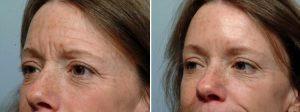 Glabella Injections By Dr. Steven Pearlman, Plastic Surgeon In New York City, New York
