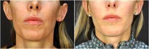 HA Fillers Were Injected By Dr. Goesel Anson, Plastic Surgeons In The Clark County, Nevada (1)
