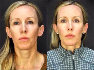 HA Fillers Were Injected By Dr. Goesel Anson, Plastic Surgeons In The Clark County, Nevada (3)