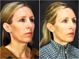 HA Fillers Were Injected By Dr. Goesel Anson, Plastic Surgeons In The Clark County, Nevada (4)