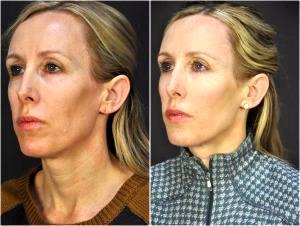 HA Fillers Were Injected By Dr. Goesel Anson, Plastic Surgeons In The Clark County, Nevada (5)
