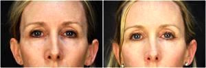 HA Fillers Were Injected By Dr. Goesel Anson, Plastic Surgeons In The Clark County, Nevada (6)