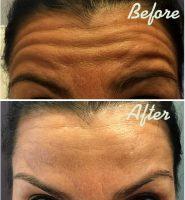 Horizontal Lines Across The Forehead Are Usually Injected In Conjunction With The Glabella Lines