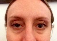 How Common Is Droopy Eye After Botox
